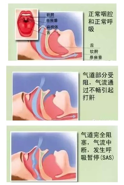 呼吸機(jī)可以完全治愈睡眠呼吸暫停嗎？